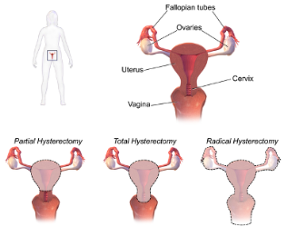 Hysterectomy Diagram