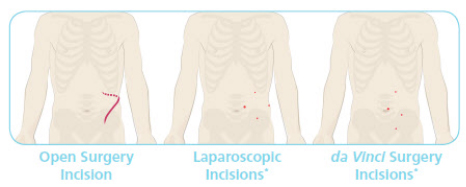 Robotic Hernia Surgery